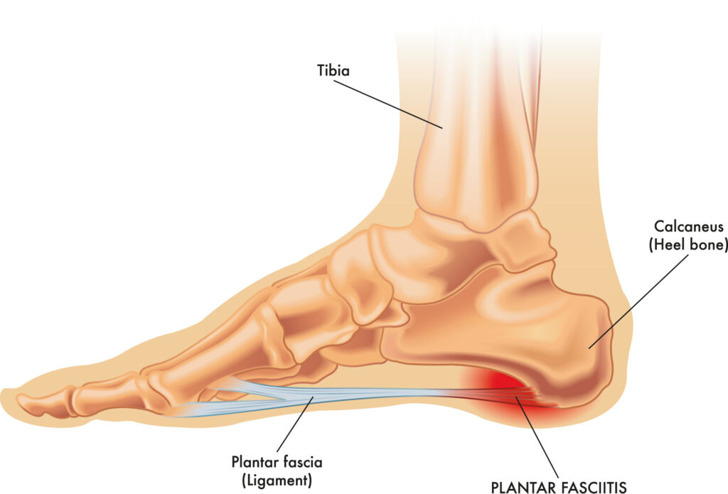 sintomas de fascitis plantar